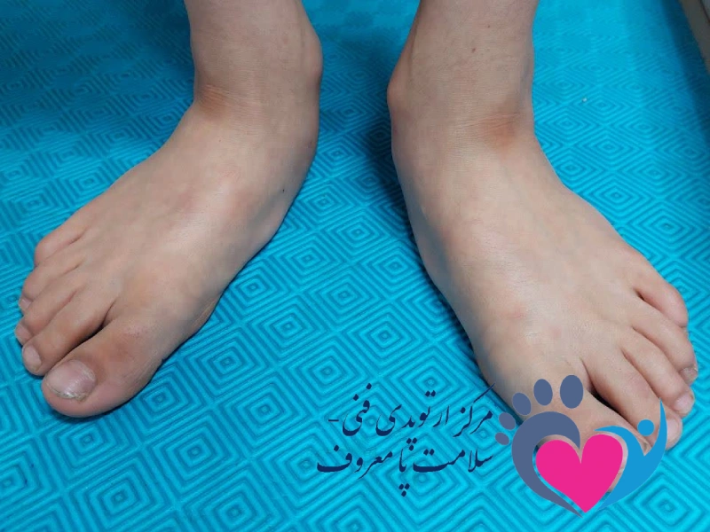 صافی کف پا در کودکان