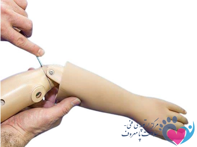 پروتز دست در اصفهان