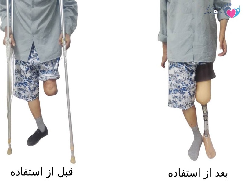 پروتز زیر زانو در اصفهان