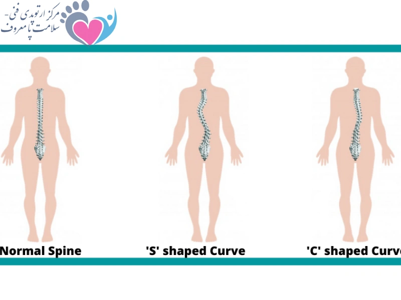اسکولیوز چیست؟