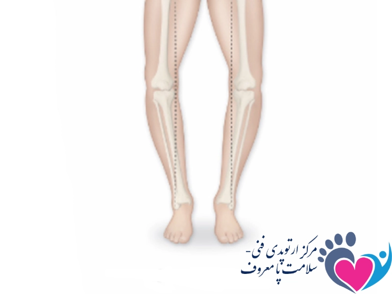 زانوی پرانتزی