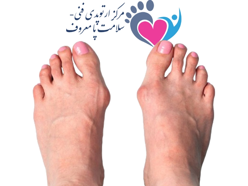 انحراف شست پا