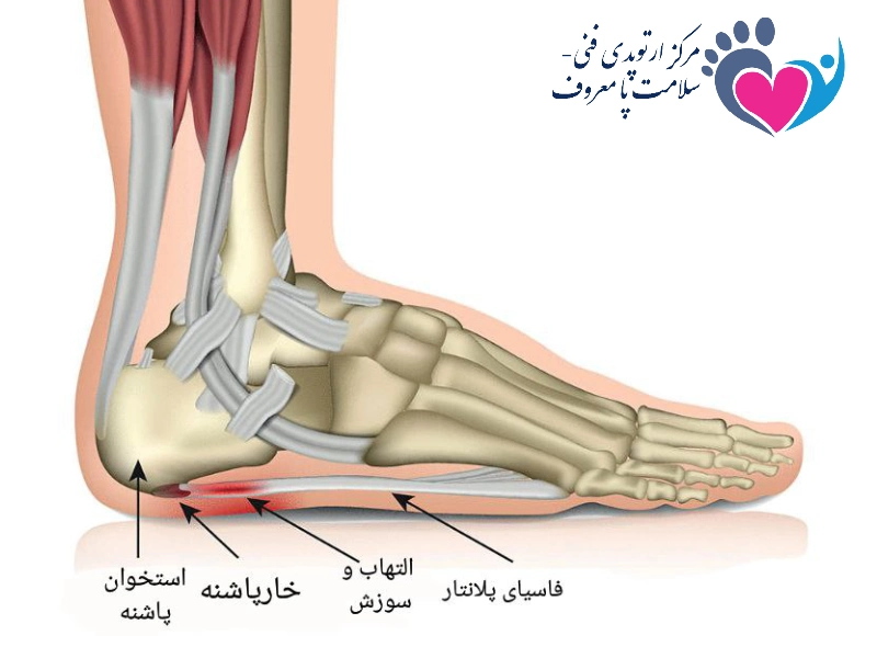 درمان خارپاشنه