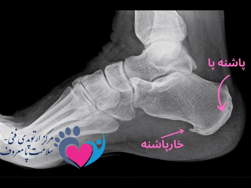 خارپاشنه چیست؟