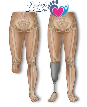 ساخت پروتز زیر زانو در اصفهان