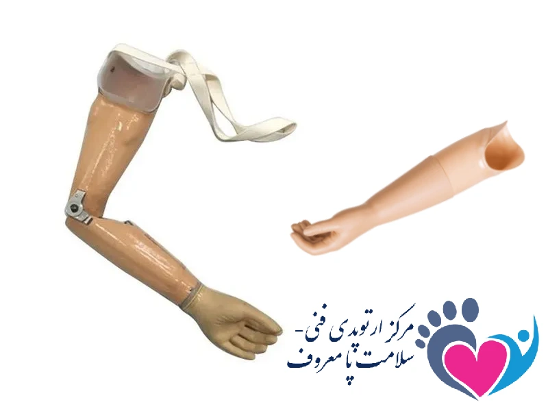 پروتز آرنج